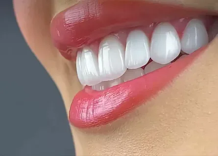 Hollywood Smile Planung